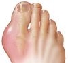 r7 gout