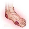Diabetes-and-Your-Feet